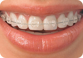Ortodoncia - Dentistas Especializados