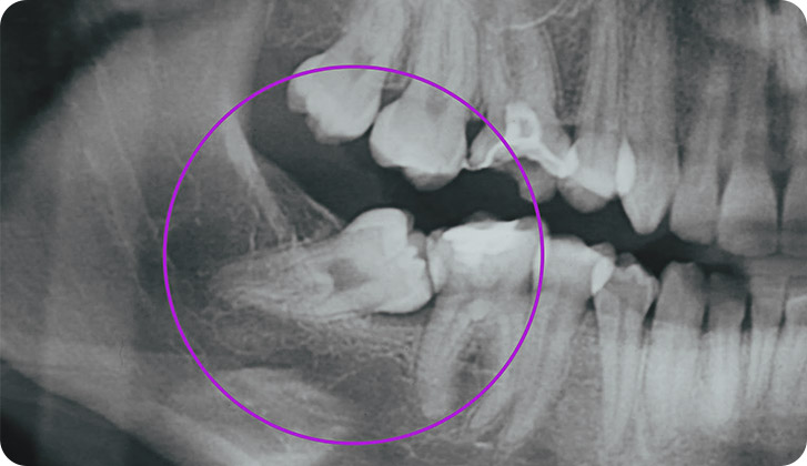 Cirugía 3 molar